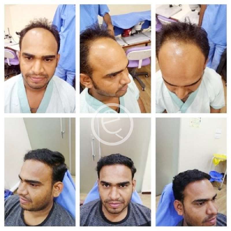 Hair Fall Treatment in Jaipur - E-Classified Jaipur